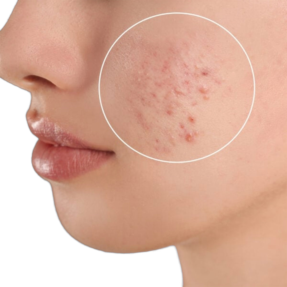 Acne Scars Treatment