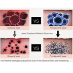 Carbon Peel Picosecond Laser Tattoo Removal Machine freckle Pigment Removal Skin Rejuvenation