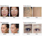 Carbon Peel Picosecond Laser Tattoo Removal Machine freckle Pigment Removal Skin Rejuvenation