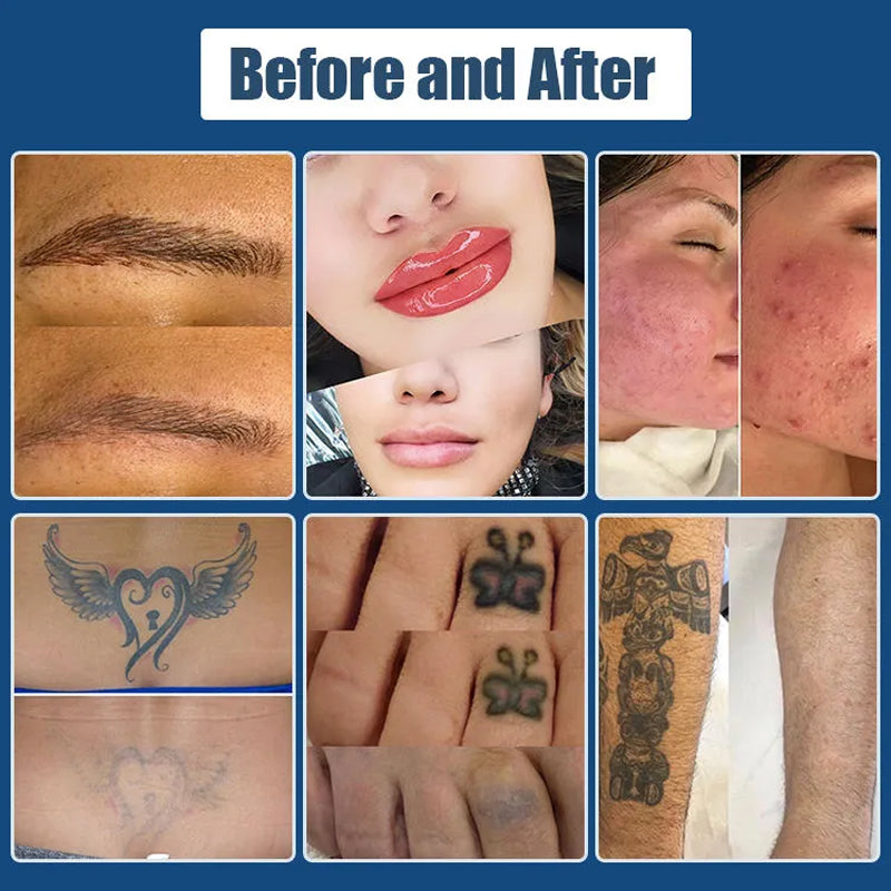 Nd YAG Picosecond Laser Tattoo Removal Machine Q Switch Pigment Freckle Removal Skin Rejuvenation