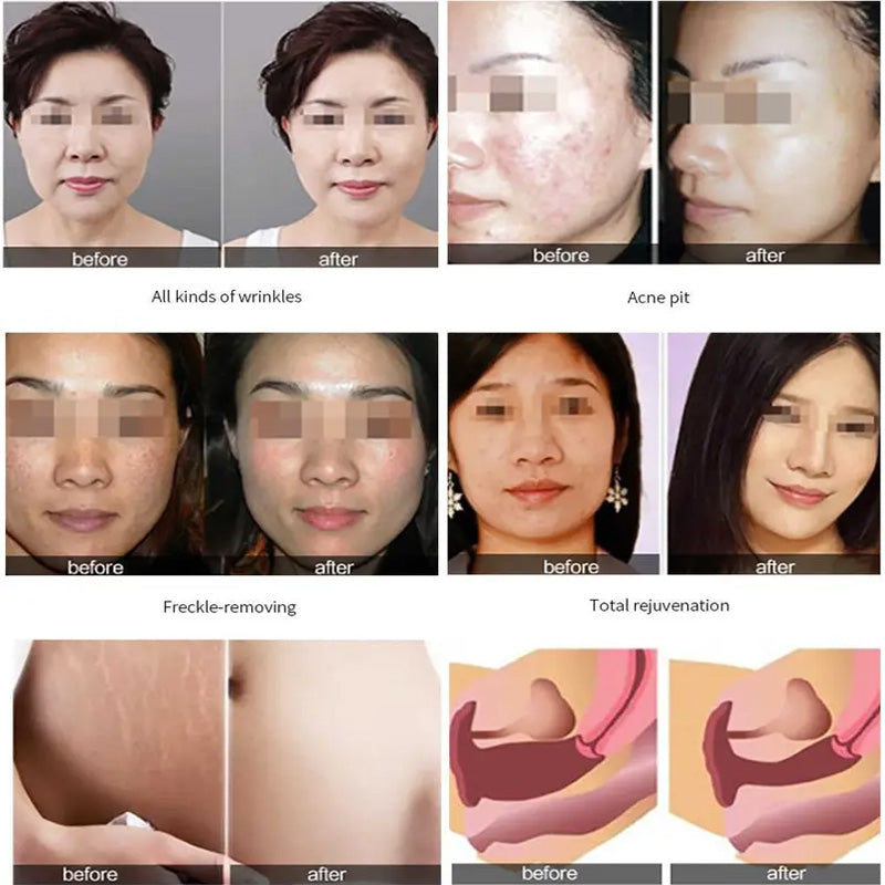 Co2 Fractional Laser Skin Vaginal Tightening Machine Rejuvenation Stretch Marks Removal