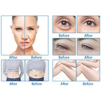 9D Hifu Body Smas Slimming Face Lifting Machine Wrinkle Removal Skin Tightening