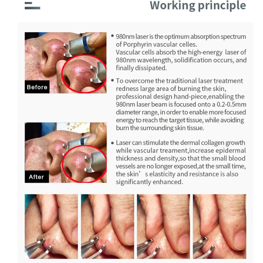 980nm Diode Laser Vascular Blood Removal Spider Vein Physical Therapy Machine