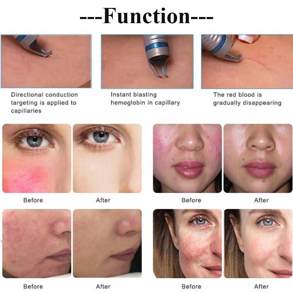 980nm Diode Laser Vascular Blood Removal Spider Vein Physical Therapy Machine