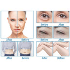 RF Fractional Microneedle 7d Hifu Machine Skin Tightening Body Face Lifting Care