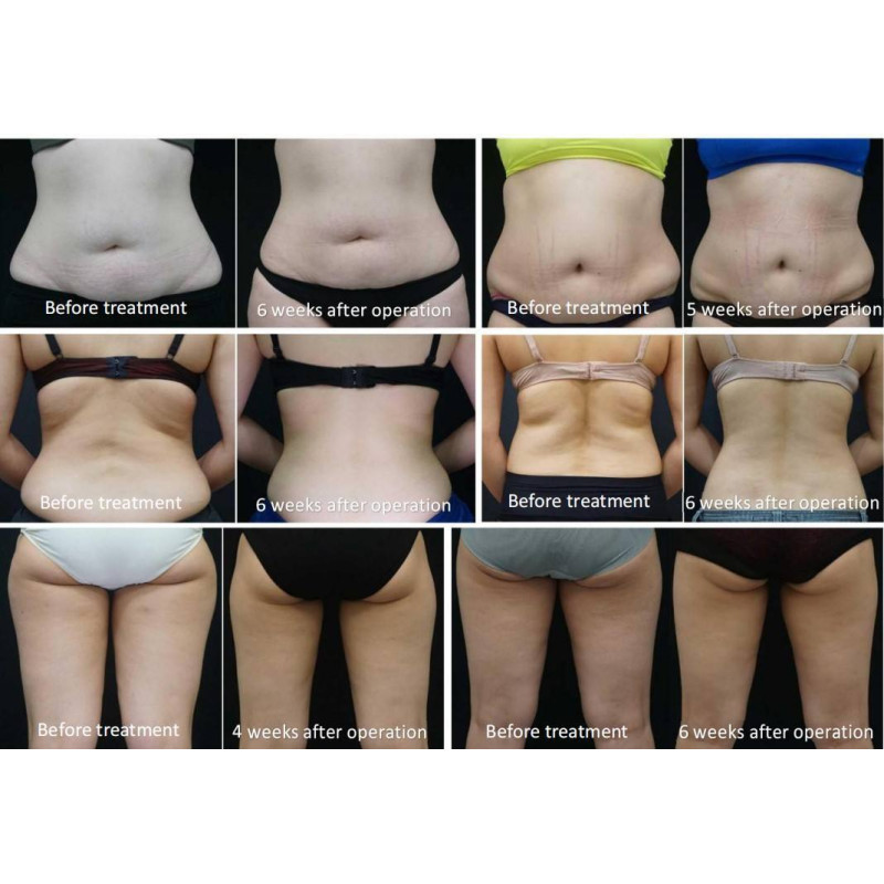 S9 Best Seller 360 Criolipolisis Weight Loss Slimming Fat Freezing Cryotherapy Machine