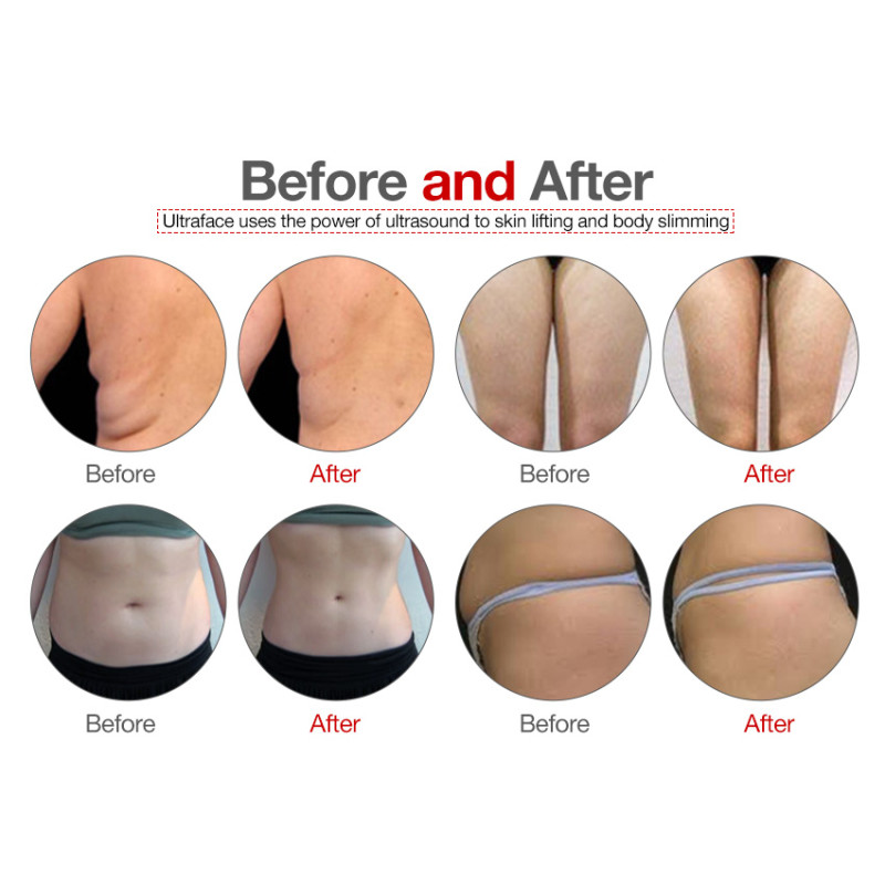 S20B 5 in 1 Cryolipolysis Fat Freezing Cavitation RF Slimming Machine